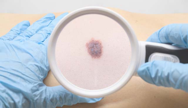 Mohs Micrographic Surgery provided by Carolina Dermatology of Greenville | Dermatologists